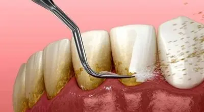 آیا جرم‌گیری باعث فاصله بین دندان‌ها می‌شود؟
