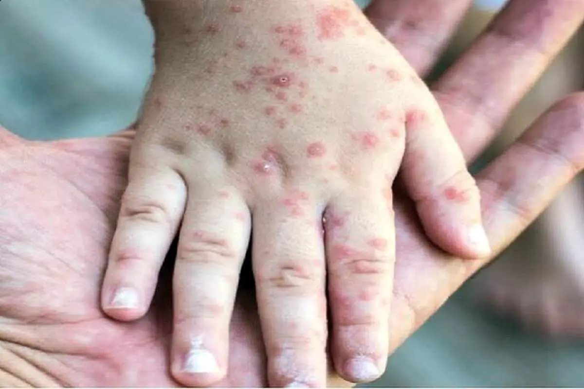 ۷۱۴ مورد ابتلا به سرخک در ایران ثبت شد
