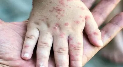 ۷۱۴ مورد ابتلا به سرخک در ایران ثبت شد
