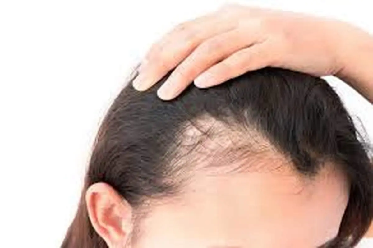 راه حل های ساده برای درمان ریزش موی شقیقه ها با نسخه های طب سنتی
