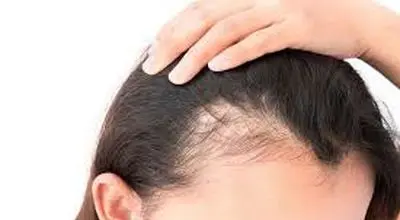 راه حل های ساده برای درمان ریزش موی شقیقه ها با نسخه های طب سنتی
