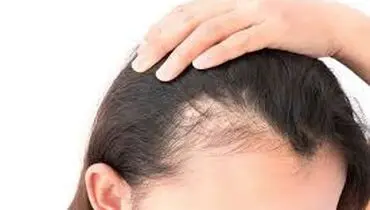 راه حل های ساده برای درمان ریزش موی شقیقه ها با نسخه های طب سنتی
