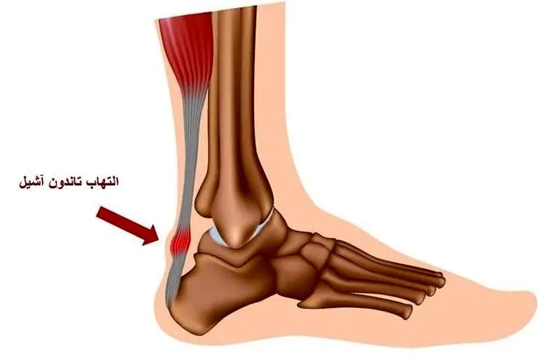 تورم تاندون آشیل