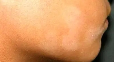دلیل لکه‌های سفید روی پوست کودکان + روش‌های درمان آن