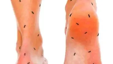 چگونه سوزن سوزن شدن بدن را درمان کنیم؟
