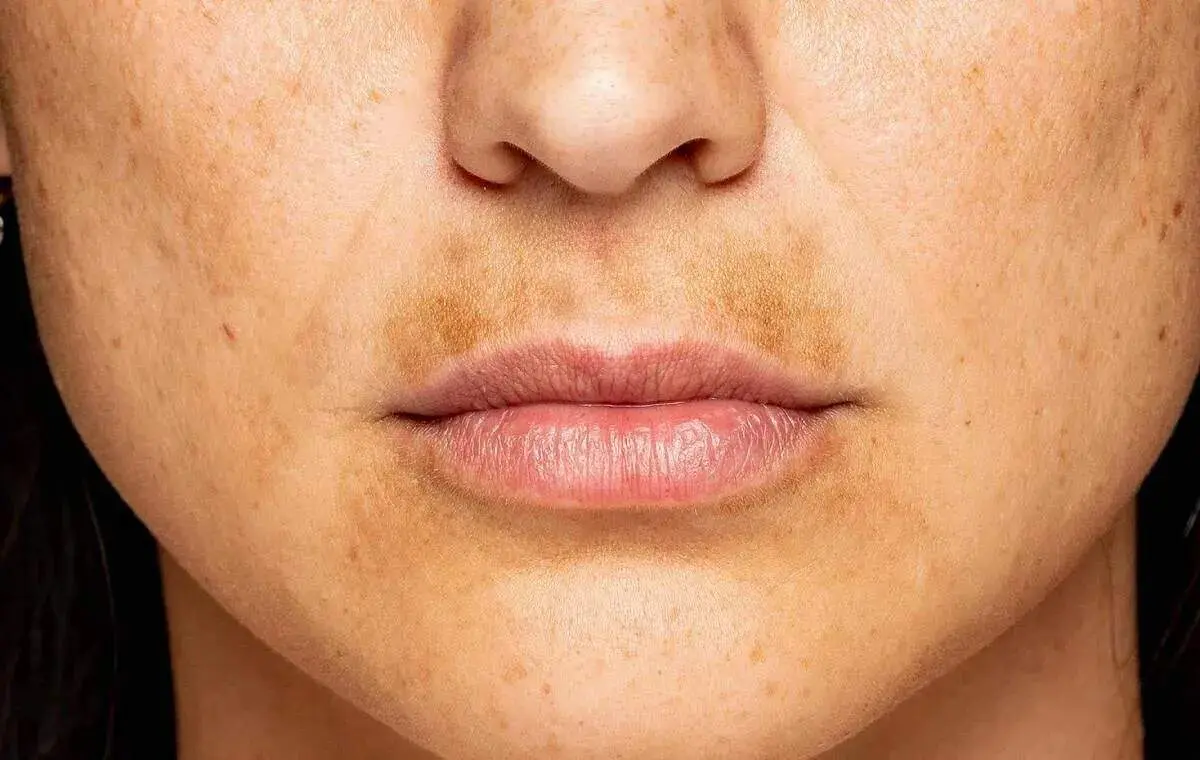 خوراکی‌هایی که سلامت پوست را تهدید می‌کنند

