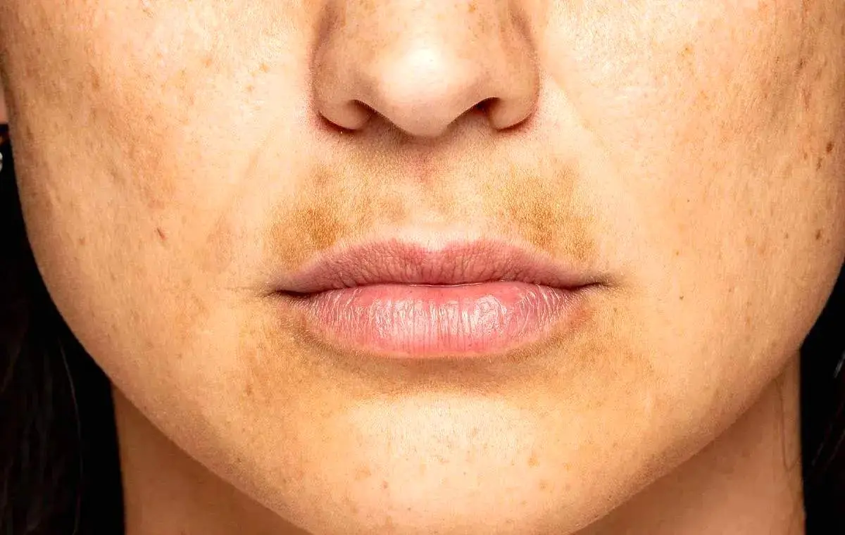 خوراکی‌هایی که سلامت پوست را تهدید می‌کنند

