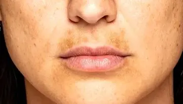 خوراکی‌هایی که سلامت پوست را تهدید می‌کنند

