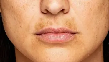 خوراکی‌هایی که سلامت پوست را تهدید می‌کنند

