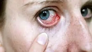 درمان حساسیت چشم به نور در طب سنتی