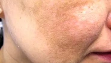 عواملی که با رعایت نکردن آنها رنگ پوستتان تیره می‌شود
