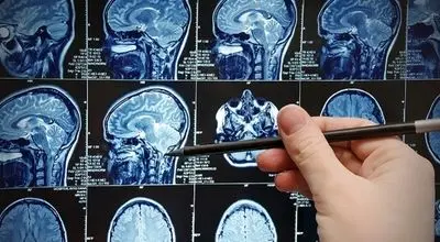 سرطان مغز؛ نشانه‌هایی که نباید نادیده گرفت

