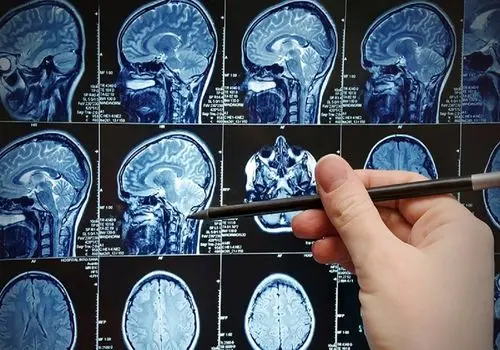 سرطان مغز؛ نشانه‌هایی که نباید نادیده گرفت

