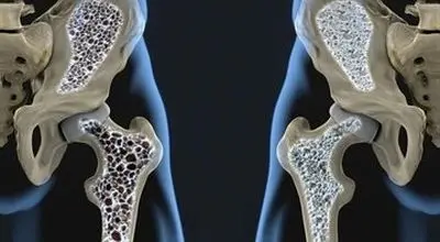  این علائم را جدی بگیرید تا به پوکی استخوان مبتلا نشوید!
