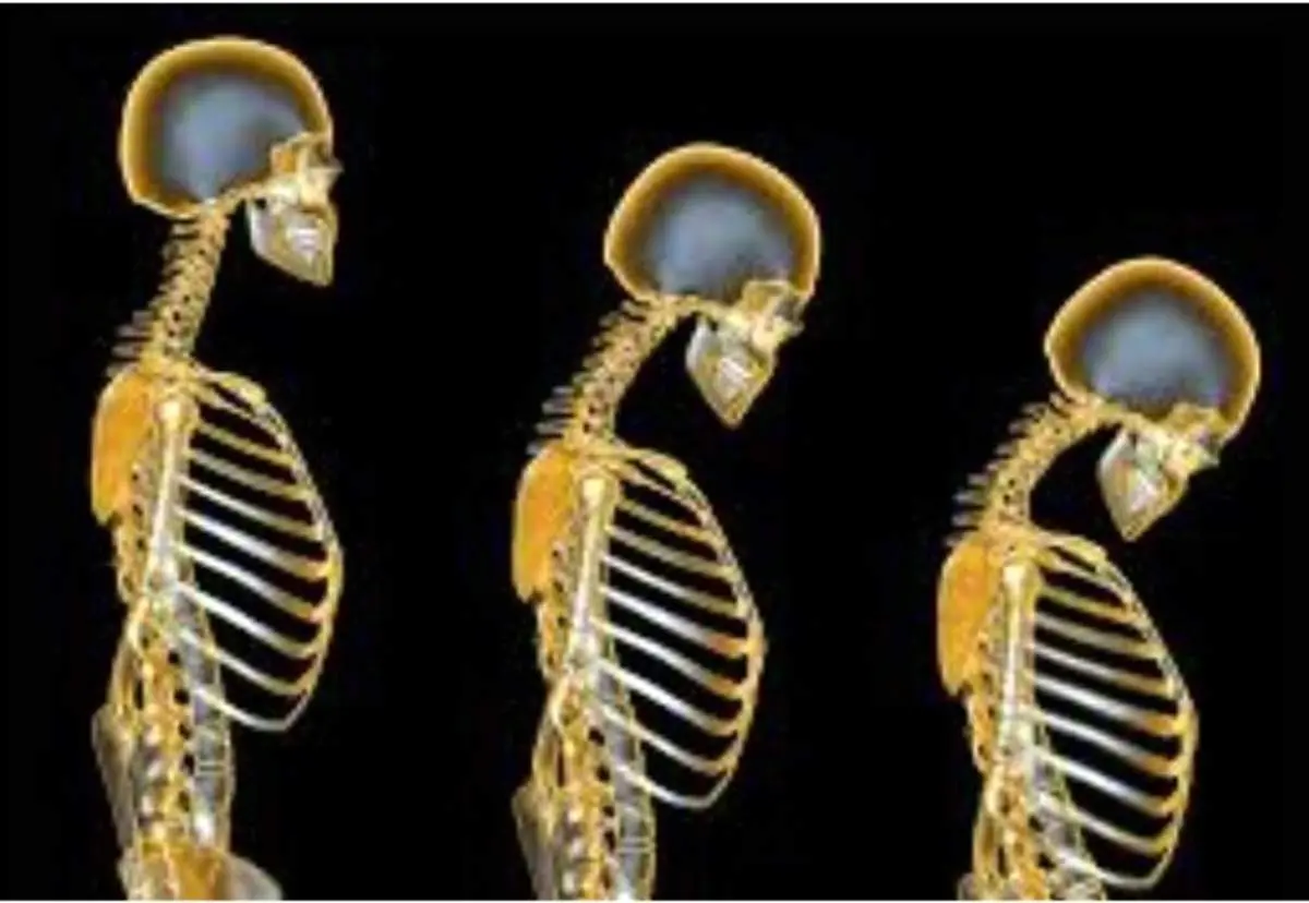 اگر این علائم دارید،درمعرض پوکی استخوان هستید