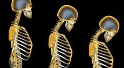 اگر این علائم دارید،درمعرض پوکی استخوان هستید