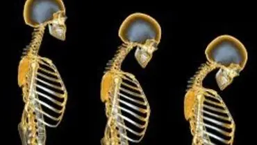 اگر این علائم دارید،درمعرض پوکی استخوان هستید