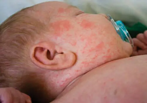 زنگ خطر به صدا درآمد ؛ آمار ابتلا به سرخک صعودی شد