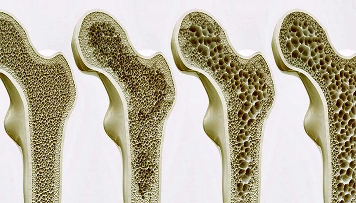 osteoporosis-01.jpg