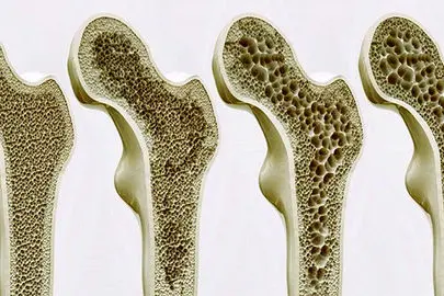 این علائم به شما میگوید دارید پوکی استخوان میگیرید
