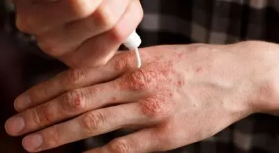 رابطه آلودگی هوا با ابتلا به بیماری‌های خودایمنی

