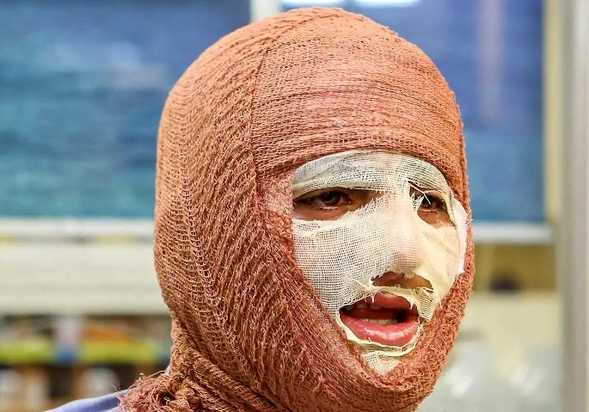 شناخت انواع سوختگی در حملات هوایی

