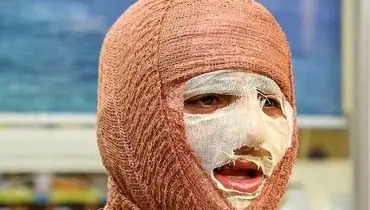 شناخت انواع سوختگی در حملات هوایی

