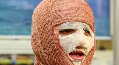 شناخت انواع سوختگی در حملات هوایی

