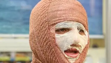 شناخت انواع سوختگی در حملات هوایی

