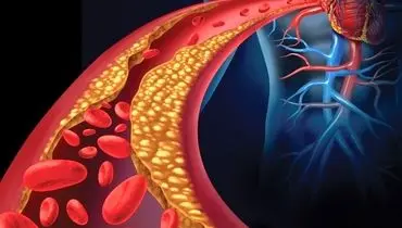 از چربی خون بالا چه می دانید؟

