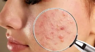 این مواد غذایی خوشمزه باعث بروز آکنه و جوش می‌شوند
