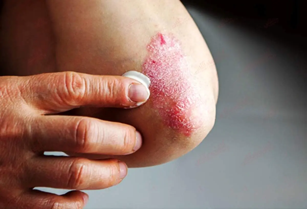 دلایل نکندن زخم خشک نشده
