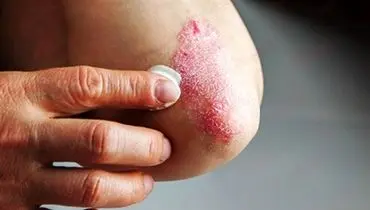 دلایل نکندن زخم خشک نشده
