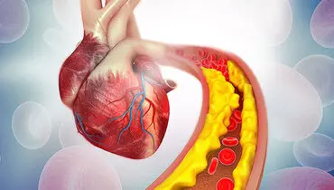 از کلسترول و تری گلیسرید بالا رنج می‌برید؟ این راهکارها برای شماست