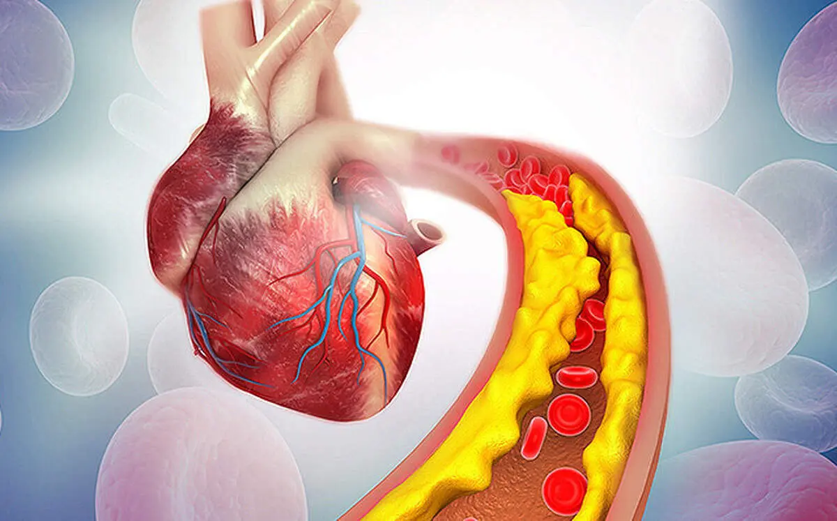 از کلسترول و تری گلیسرید بالا رنج می‌برید؟ این راهکارها برای شماست