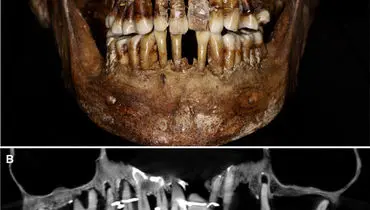 دندان ۱۶۰۰ ساله، کلید رمزگشایی از زندگی زاهدانه یک زن باستانی شد
