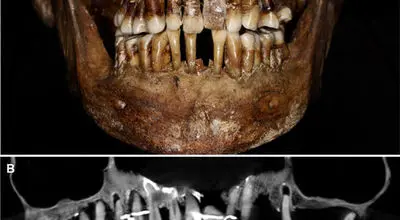دندان ۱۶۰۰ ساله، کلید رمزگشایی از زندگی زاهدانه یک زن باستانی شد
