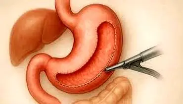 دانستنی هایی درباره جراحی چاقی