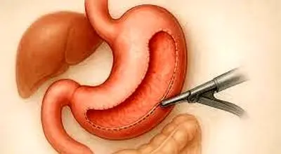 دانستنی هایی درباره جراحی چاقی