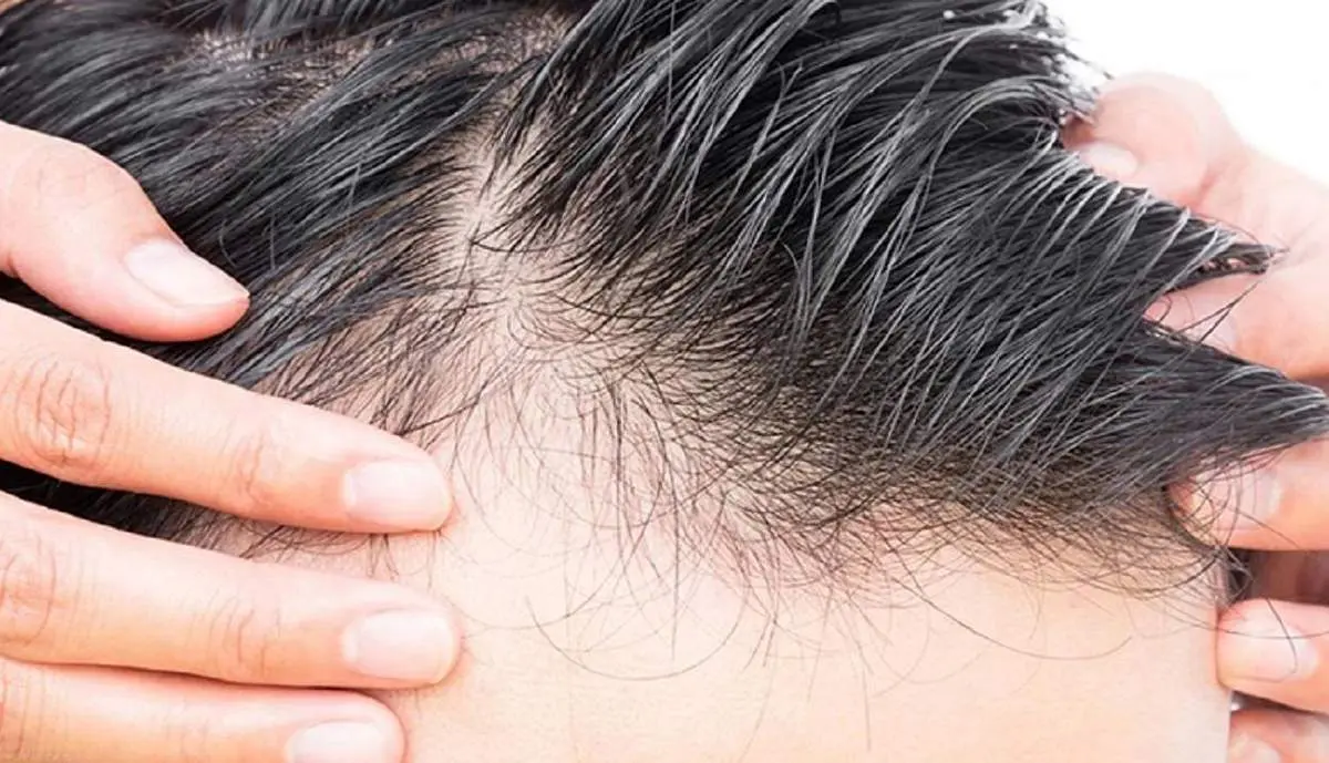 راهکارهای اساسی برای درمان ریزش مو+ موشن گرافی