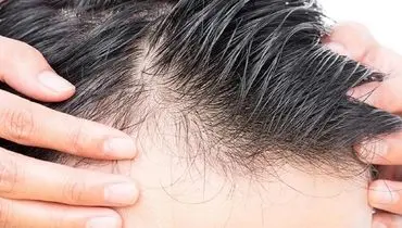 راهکارهای اساسی برای درمان ریزش مو+ موشن گرافی

