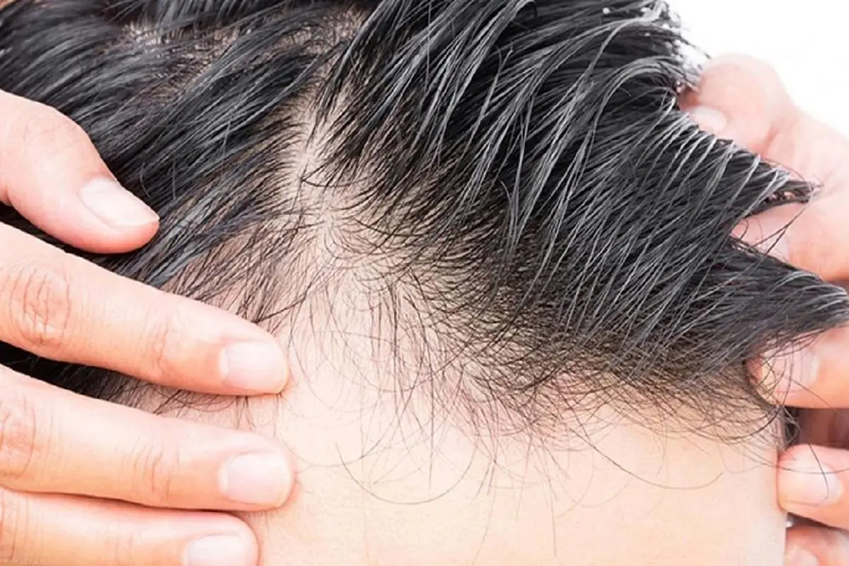راهکارهای اساسی برای درمان ریزش مو+ موشن گرافی