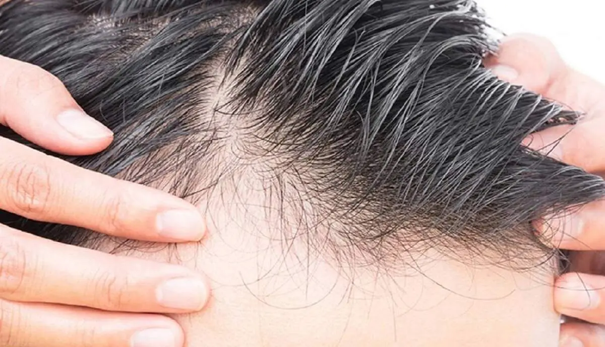 راهکارهای اساسی برای درمان ریزش مو+ موشن گرافی

