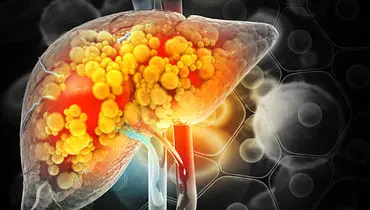 تنها روش مؤثر برای درمان کبد چرب معرفی شد

