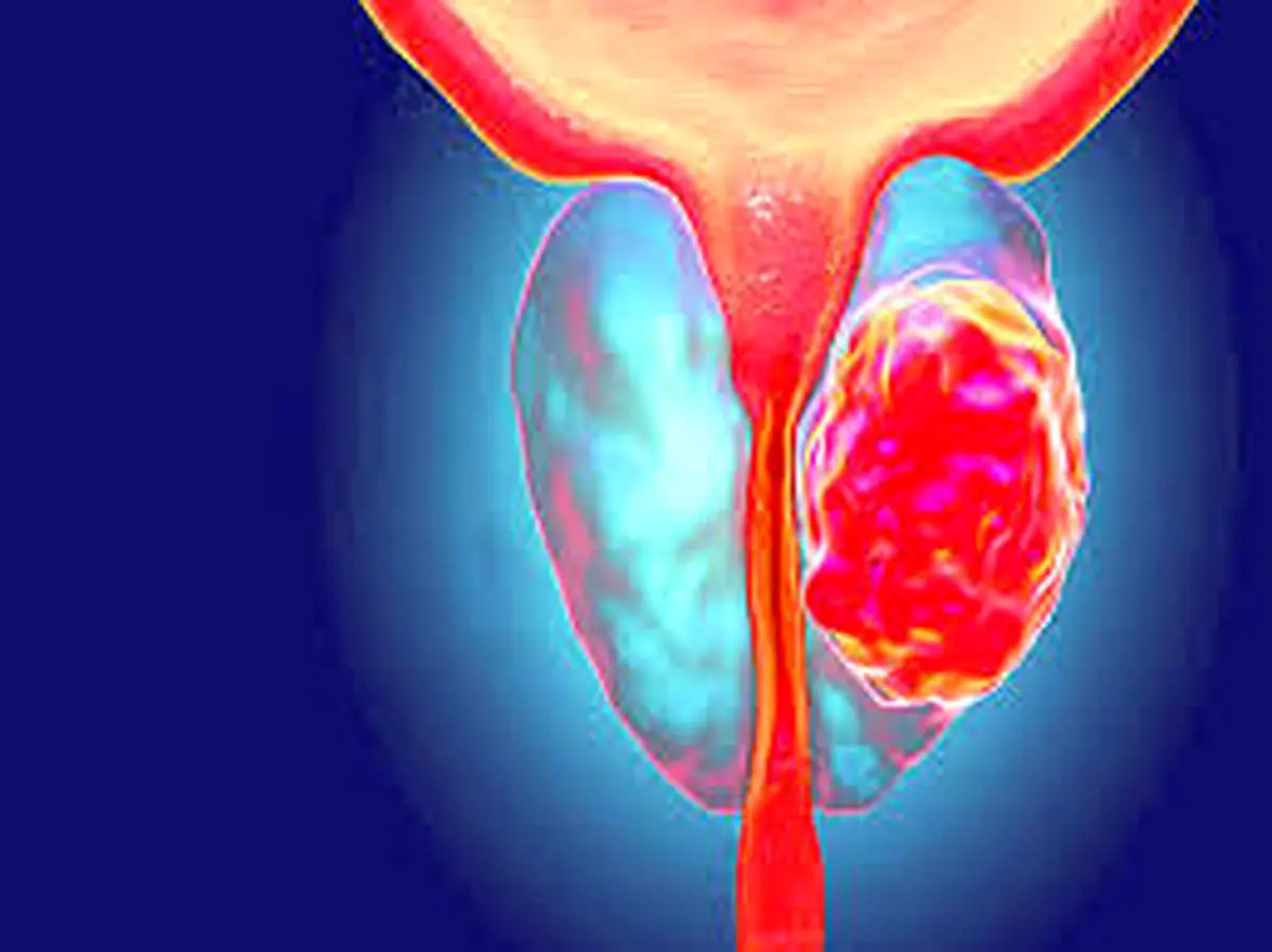 چرا به سرطان پروستات دچار می­شویم؟
