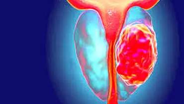 چرا به سرطان پروستات دچار می­شویم؟
