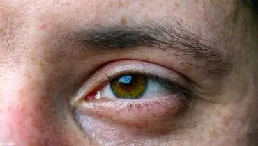 شکستگی کاسه چشم چگونه قابل تشخیص و بهبود است ؟
