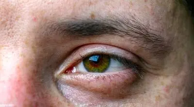 شکستگی کاسه چشم چگونه قابل تشخیص و بهبود است ؟
