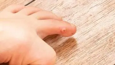 میخچه چگونه درمان می‌شود؟