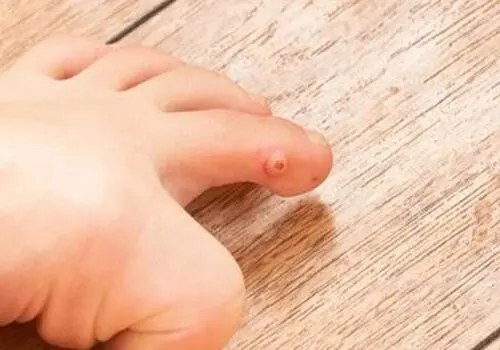 میخچه چیست چگونه درمان می‌شود؟